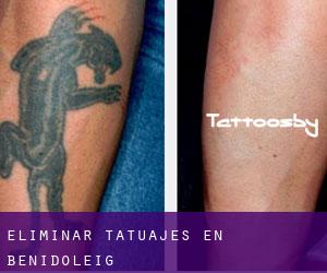 Eliminar tatuajes en Benidoleig
