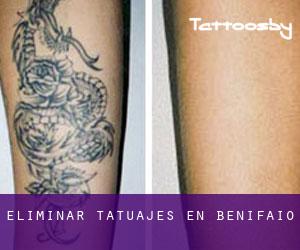 Eliminar tatuajes en Benifaió