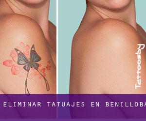 Eliminar tatuajes en Benilloba