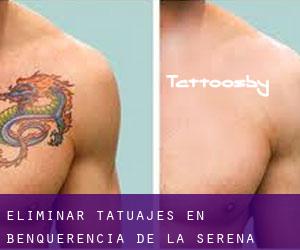 Eliminar tatuajes en Benquerencia de la Serena