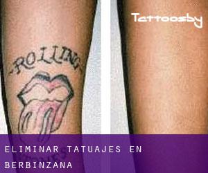 Eliminar tatuajes en Berbinzana
