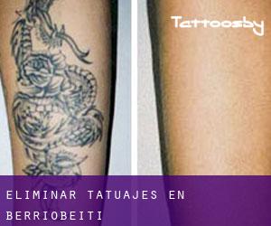 Eliminar tatuajes en Berriobeiti