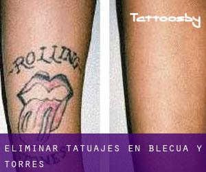 Eliminar tatuajes en Blecua y Torres