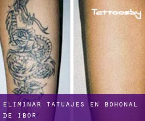 Eliminar tatuajes en Bohonal de Ibor