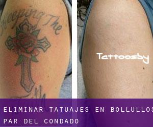 Eliminar tatuajes en Bollullos par del Condado
