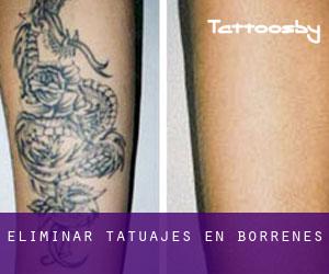 Eliminar tatuajes en Borrenes