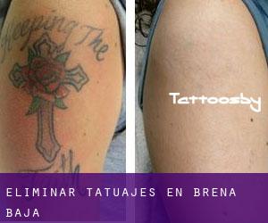 Eliminar tatuajes en Breña Baja