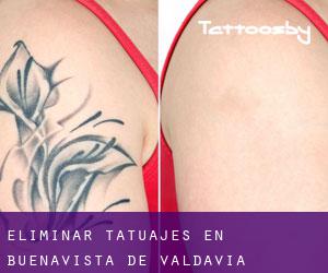 Eliminar tatuajes en Buenavista de Valdavia