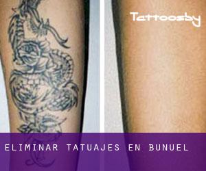 Eliminar tatuajes en Buñuel