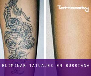 Eliminar tatuajes en Burriana