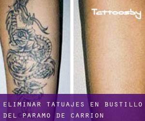 Eliminar tatuajes en Bustillo del Páramo de Carrión