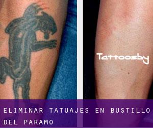 Eliminar tatuajes en Bustillo del Páramo