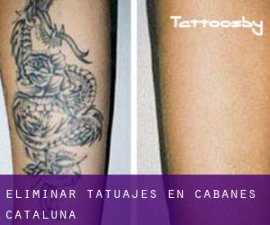 Eliminar tatuajes en Cabanes (Cataluña)