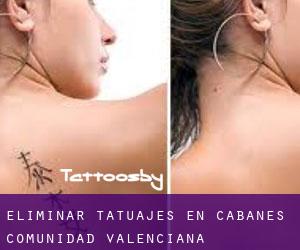 Eliminar tatuajes en Cabanes (Comunidad Valenciana)