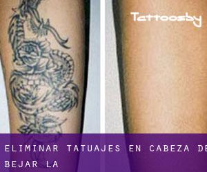 Eliminar tatuajes en Cabeza de Béjar (La)