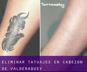 Eliminar tatuajes en Cabezón de Valderaduey