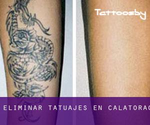 Eliminar tatuajes en Calatorao