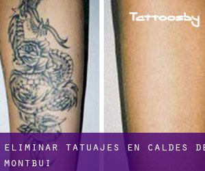 Eliminar tatuajes en Caldes de Montbui