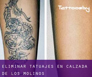Eliminar tatuajes en Calzada de los Molinos