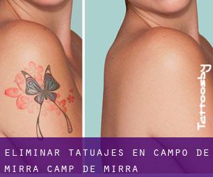 Eliminar tatuajes en Campo de Mirra / Camp de Mirra