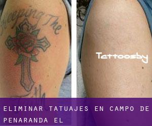 Eliminar tatuajes en Campo de Peñaranda (El)