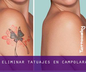 Eliminar tatuajes en Campolara