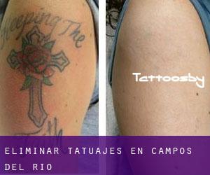 Eliminar tatuajes en Campos del Río