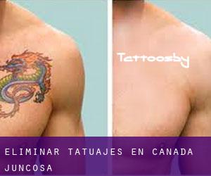 Eliminar tatuajes en Cañada Juncosa