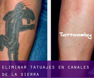 Eliminar tatuajes en Canales de la Sierra