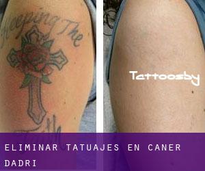 Eliminar tatuajes en Caner d'Adri