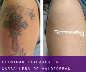 Eliminar tatuajes en Carballeda de Valdeorras