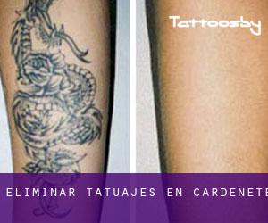 Eliminar tatuajes en Cardenete