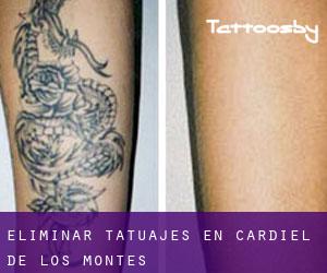 Eliminar tatuajes en Cardiel de los Montes