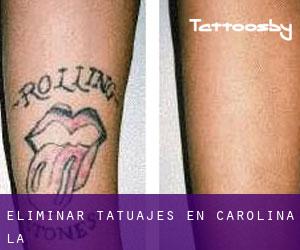 Eliminar tatuajes en Carolina (La)