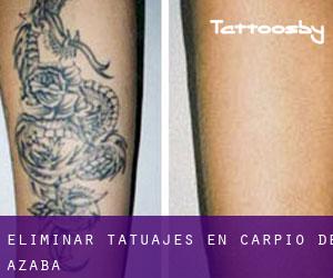 Eliminar tatuajes en Carpio de Azaba