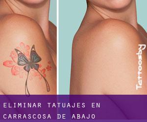 Eliminar tatuajes en Carrascosa de Abajo