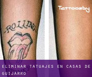 Eliminar tatuajes en Casas de Guijarro
