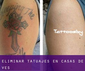 Eliminar tatuajes en Casas de Ves