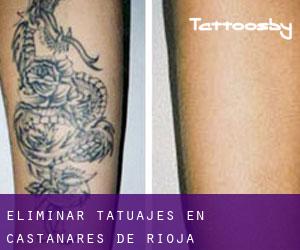 Eliminar tatuajes en Castañares de Rioja