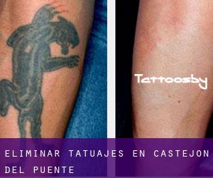 Eliminar tatuajes en Castejón del Puente