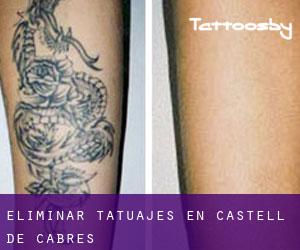 Eliminar tatuajes en Castell de Cabres