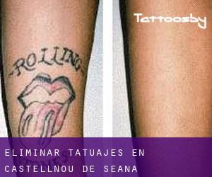 Eliminar tatuajes en Castellnou de Seana