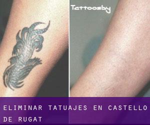 Eliminar tatuajes en Castelló de Rugat