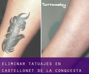 Eliminar tatuajes en Castellonet de la Conquesta