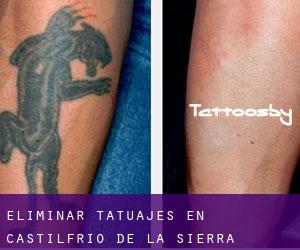 Eliminar tatuajes en Castilfrío de la Sierra