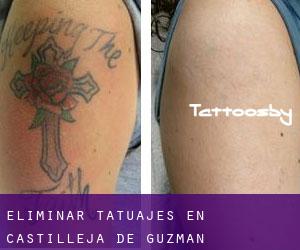 Eliminar tatuajes en Castilleja de Guzmán