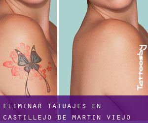 Eliminar tatuajes en Castillejo de Martín Viejo