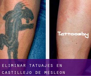 Eliminar tatuajes en Castillejo de Mesleón