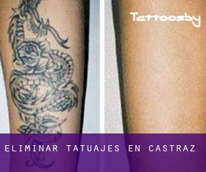 Eliminar tatuajes en Castraz