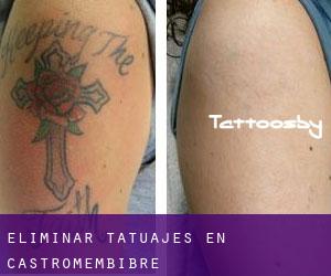 Eliminar tatuajes en Castromembibre